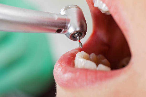 Best Emergency Dental Care for Broken or Chipped Teeth in Stanton, KY